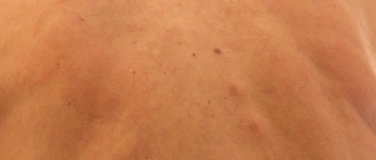 Event-Image for '2. Dortmunder Hidradenitis suppurativa Infoabend'