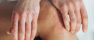 Event-Image for 'Live-Visite - Psoriasis-Komorbit&auml;ten'